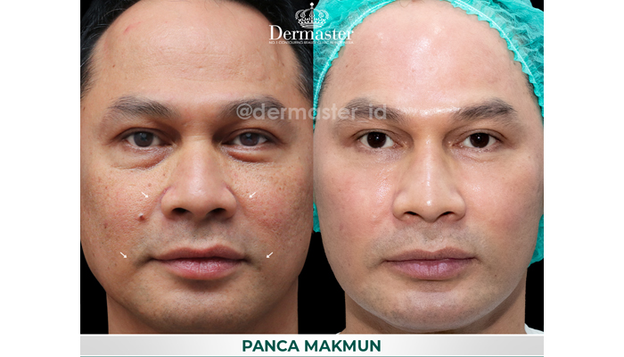 before after treatment smartxide laser